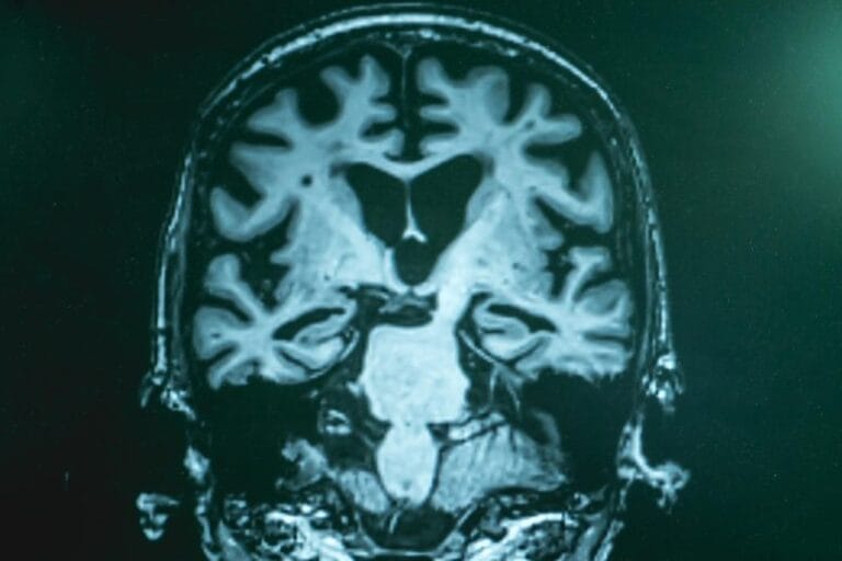 Estudo revela impacto do Alzheimer na estrutura do genoma