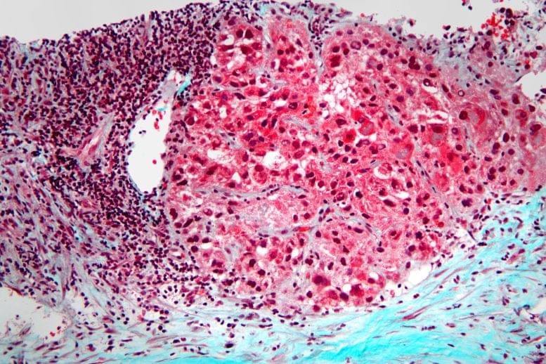 Microscope Image of Hepatocellular Carcinoma