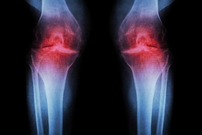 Hidrogel injetável pode revolucionar tratamento da osteoartrite