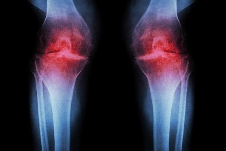 Osteoarthritis Knee