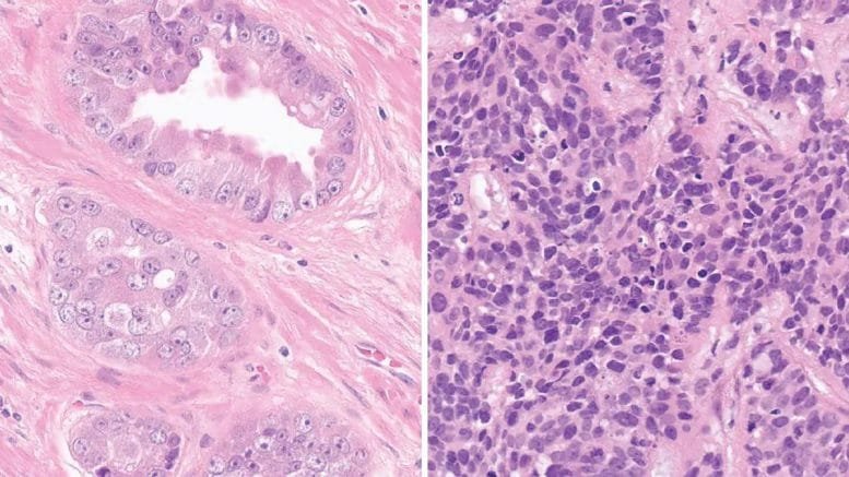 Typical Glandular Prostate Adenocarcinoma and Prostate Cancer With Transdifferentiation