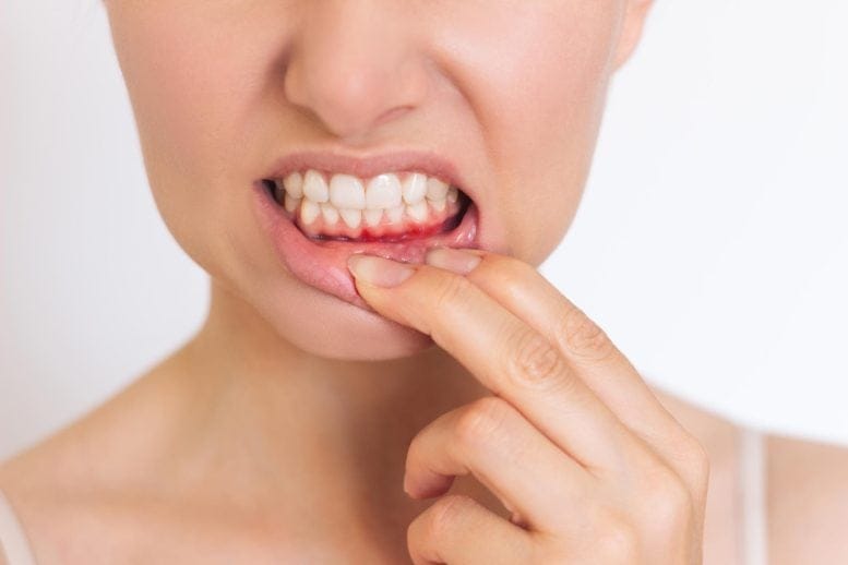 Woman Inflammation Lower Gum Disease