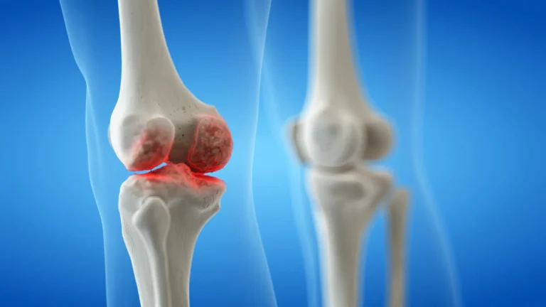 Osteoartrite no joelho: prevenção e controle eficazes