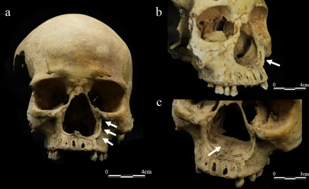 woman cut nose punishment china first archaeological evidence