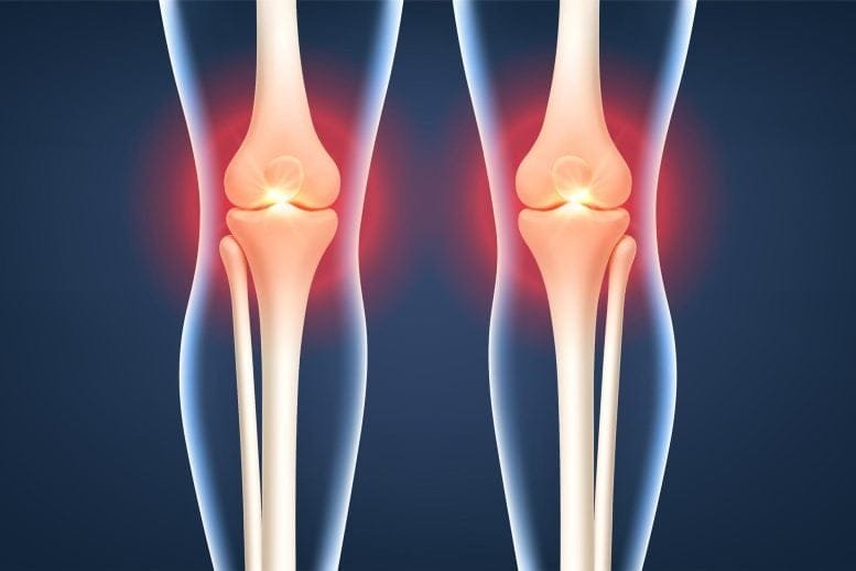 Bilateral Knee Joint Pain Inflammation