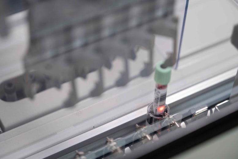 Blood Sample for Pancreatic Cancer Liquid Biopsy