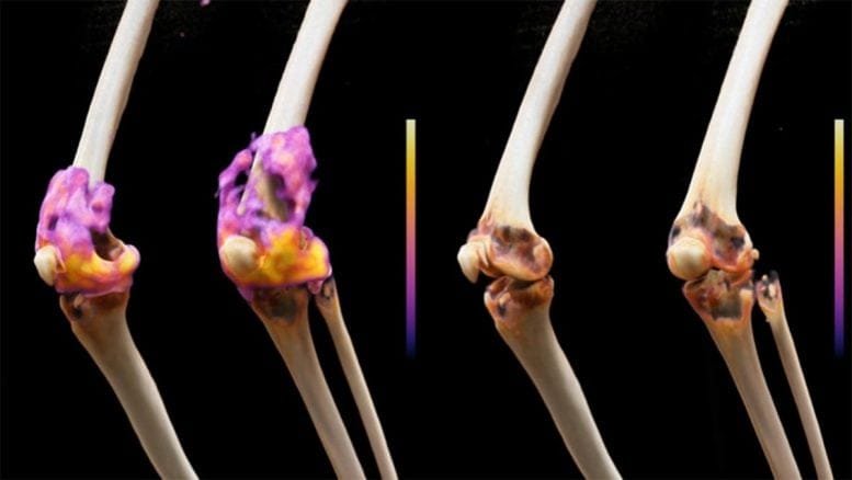 Cell Therapy Treats Severe Rheumatoid Arthritis