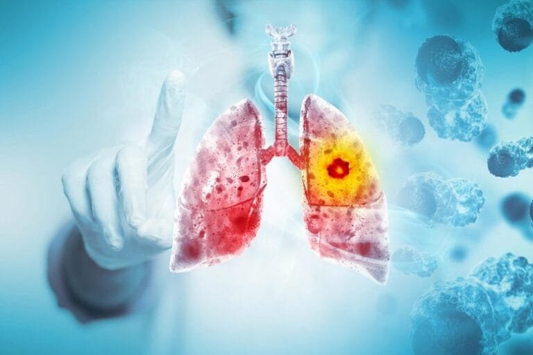 Células fibroblásticas ajudam câncer de pulmão a escapar do sistema imunológico