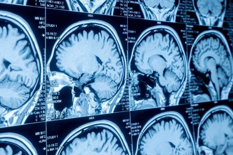 Estudo relaciona envelhecimento cerebral a bactérias intestinais
