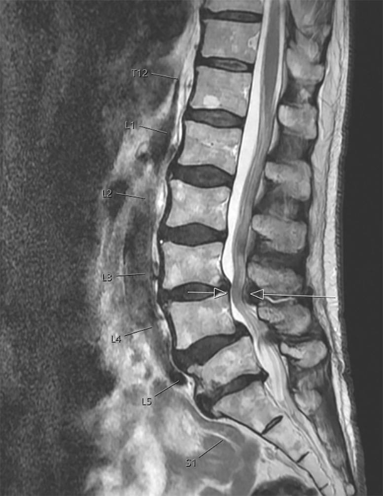 MRI Image of Spinal Stenosis