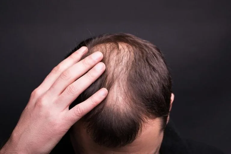 Estudo relaciona uso de Ozempic a risco genético de queda de cabelo
