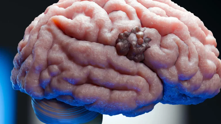 Pesquisadores identificam fraqueza em câncer cerebral letal