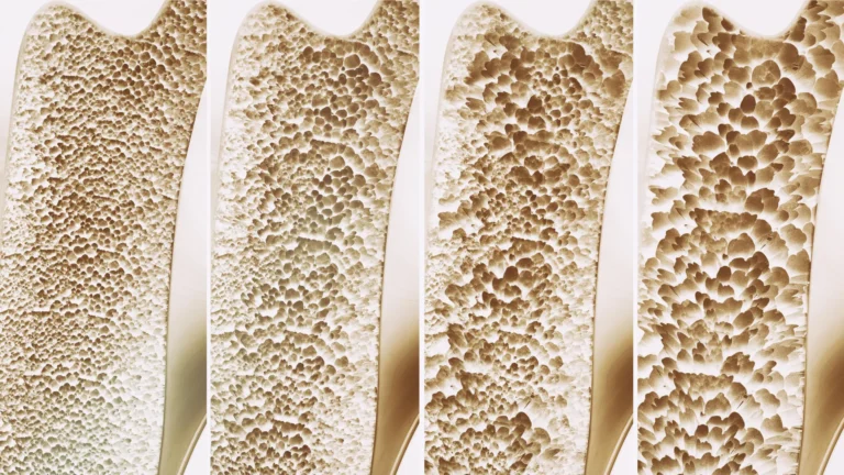 Cientistas identificam receptor que fortalece ossos e combate osteoporose