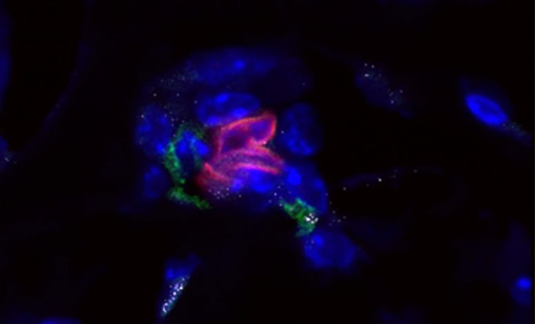 A Nest of Dormant Cancer Cells in the Bone