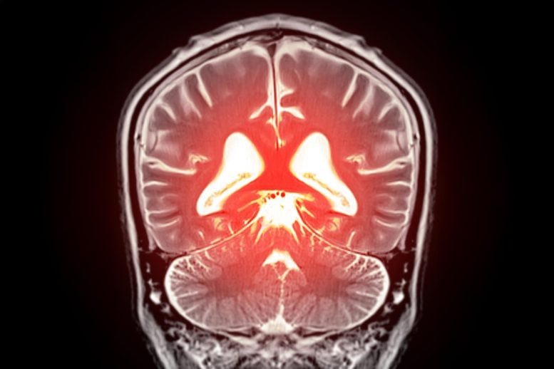 Dementia Diagnostics MRI Brain Scan