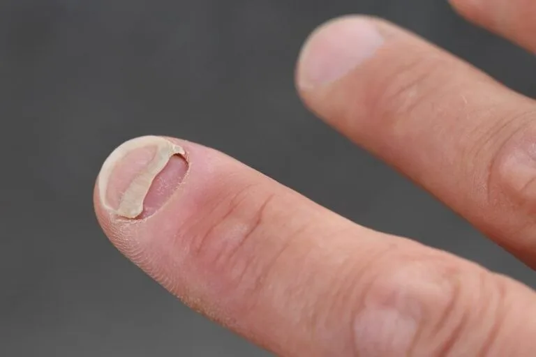 Estudo relaciona uso de agonistas GLP-1 a problemas nas unhas