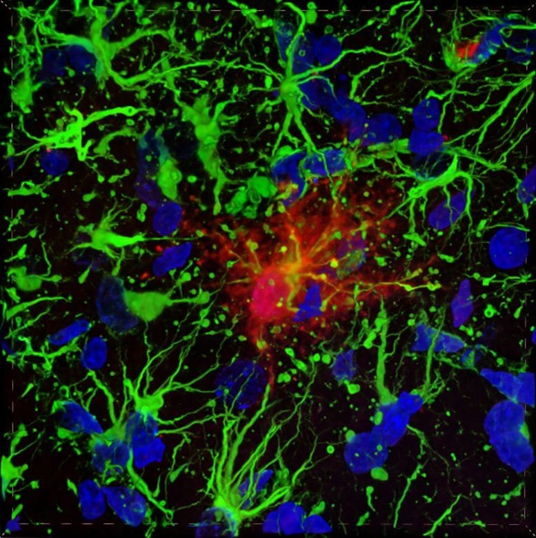 GFAP Protein Clumps in Alexander Disease Brain Cells