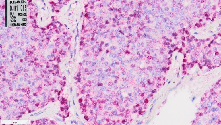 Microscopic View of High Human Prostate Cancer