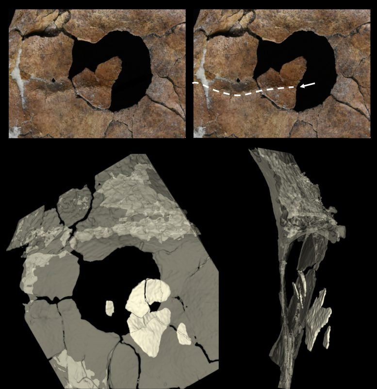 Scapula Perforation and Embedded Bone Fragments