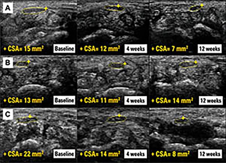 Ultrasound Images of the Median Nerve