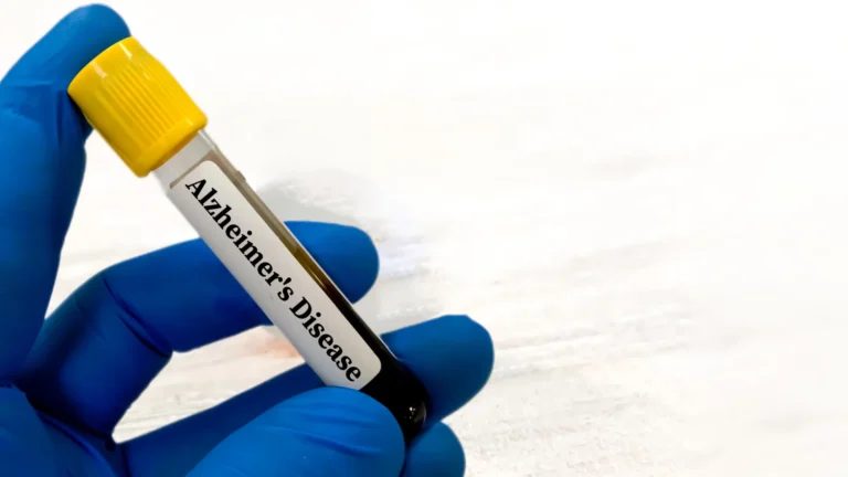 Teste de sangue pode prever risco de Alzheimer anos antes dos sintomas